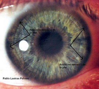 Iridologia: Anillo escamoso o borde de costra
